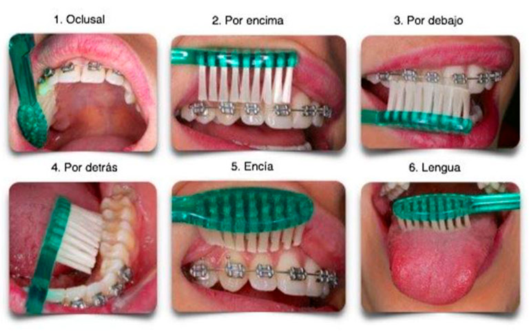 cepillado con ortodoncia