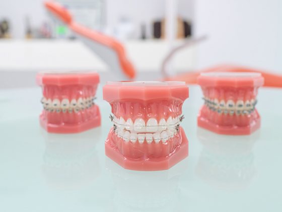 Tipos de ortodoncia con brakcets