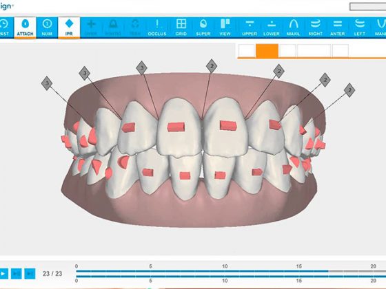 Clincheck Invisalign