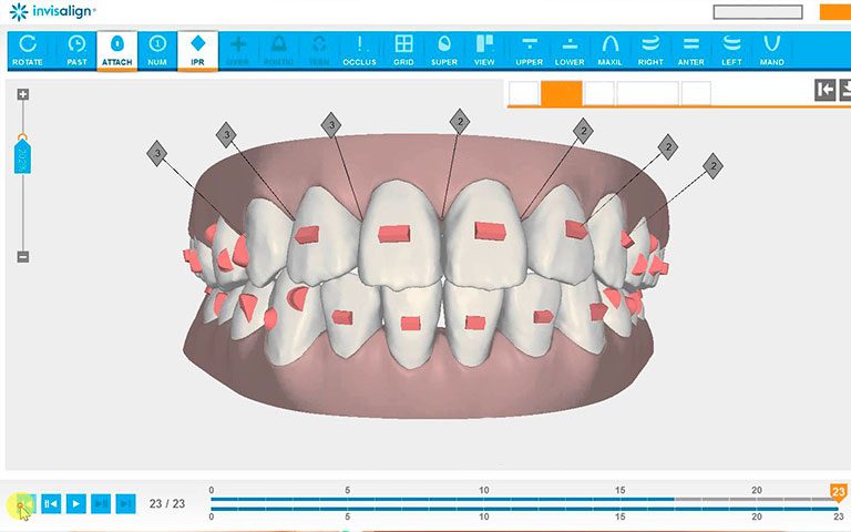 Clincheck Invisalign