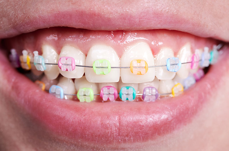 Qué son los intermaxilares en ortodoncia? Ortodoncia