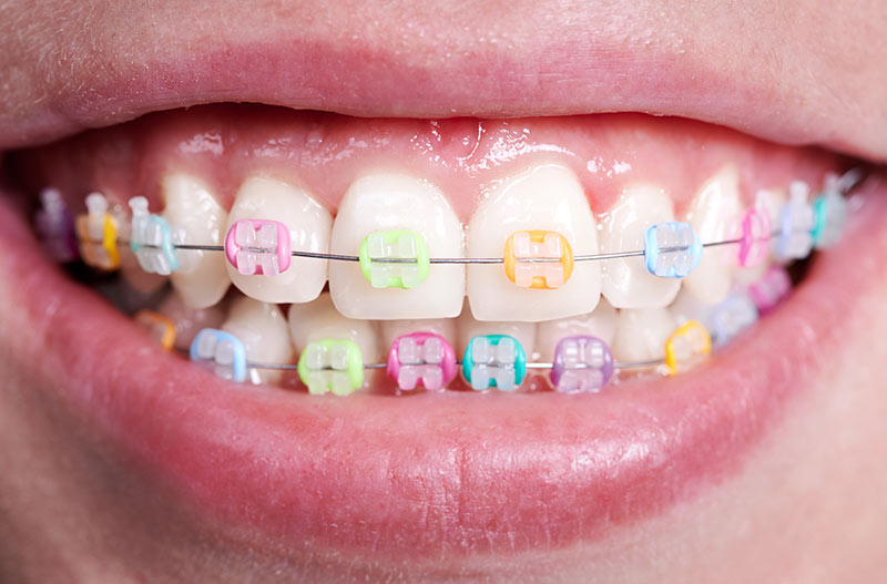 gomas colores brackets