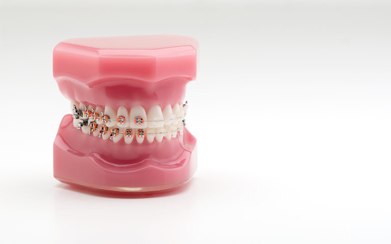 Tipos ortodoncia