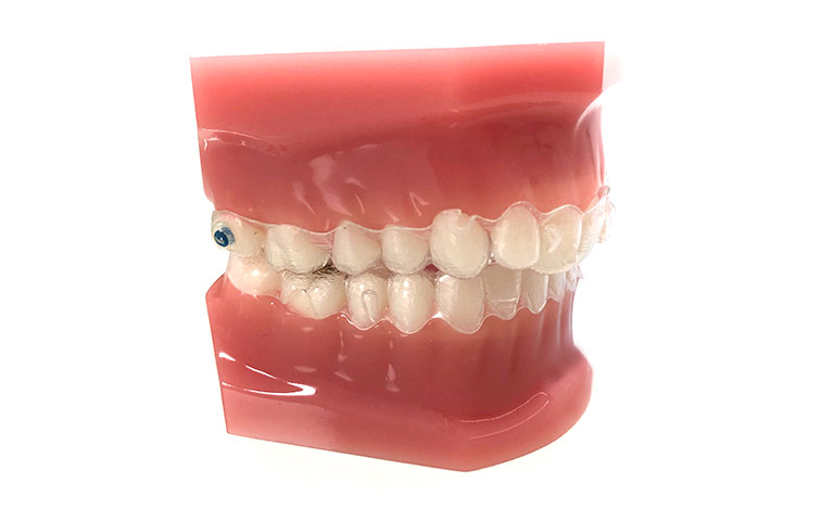 Aparatos Invisalign