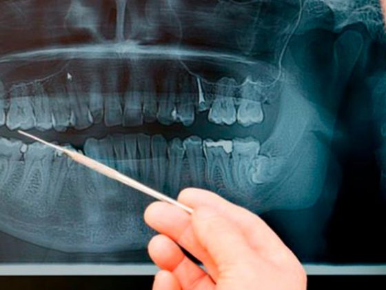 auxiliar señala radiografía de ortodoncia en zaragoza