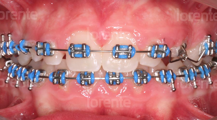 Caso clínico ortodoncia