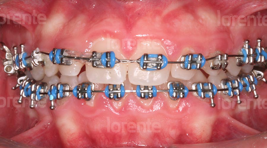 Caso clínico ortodoncia