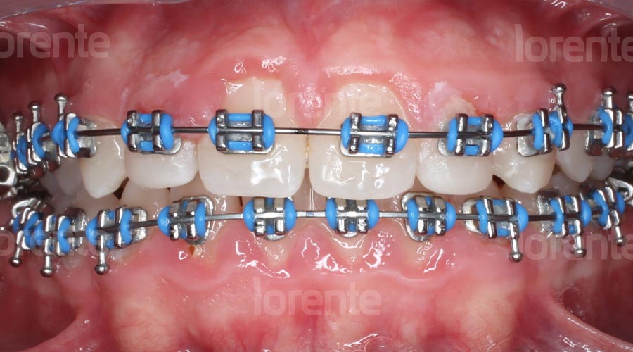 Caso clínico ortodoncia