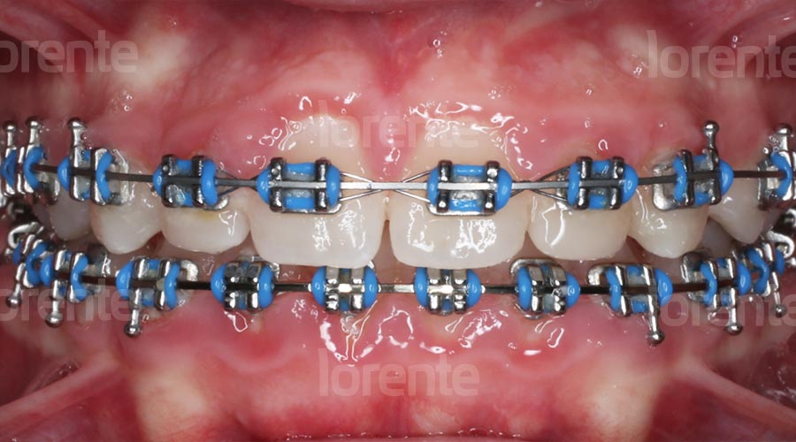 Caso clínico ortodoncia