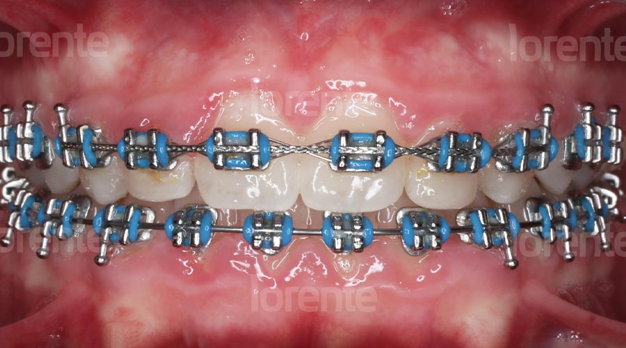 Caso clínico ortodoncia