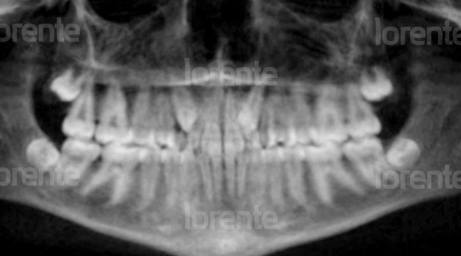 Radiografía antes caso clínico de ortodoncia con brackets