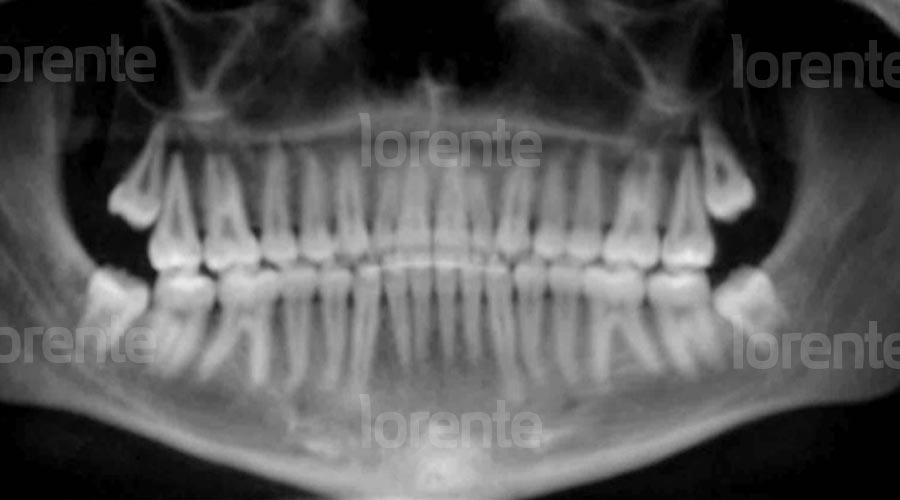 Radiografía después caso clínico de ortodoncia con brackets