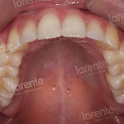 Caso clínico Ortodoncia maxilar superior