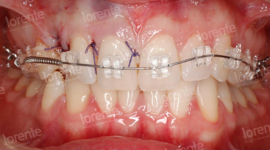 Caso clínico Ortodoncia