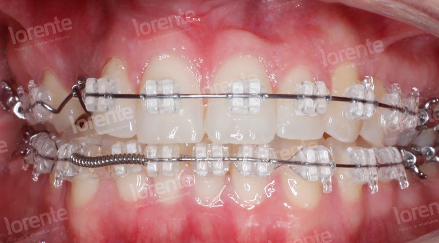Caso clínico Ortodoncia