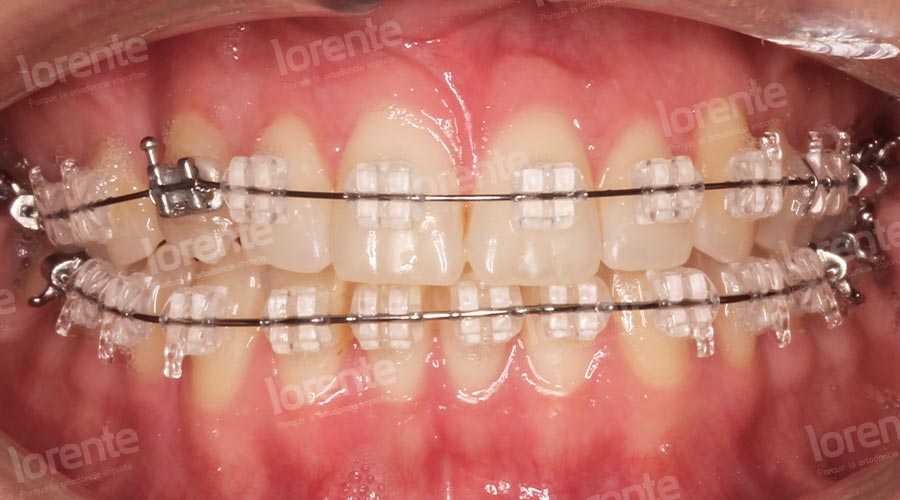 Caso clínico Ortodoncia