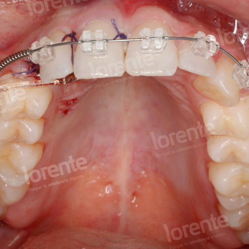 Caso clínico Ortodoncia Intraoral