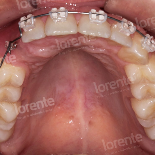 Caso clínico Ortodoncia Intraoral