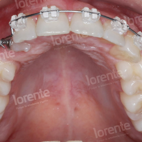 Caso clínico Ortodoncia Intraoral
