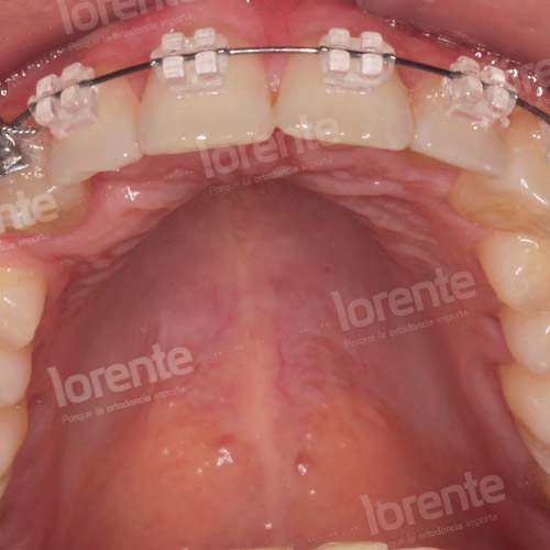Caso clínico Ortodoncia Intraoral