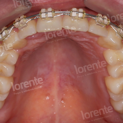 Caso clínico Ortodoncia Intraoral