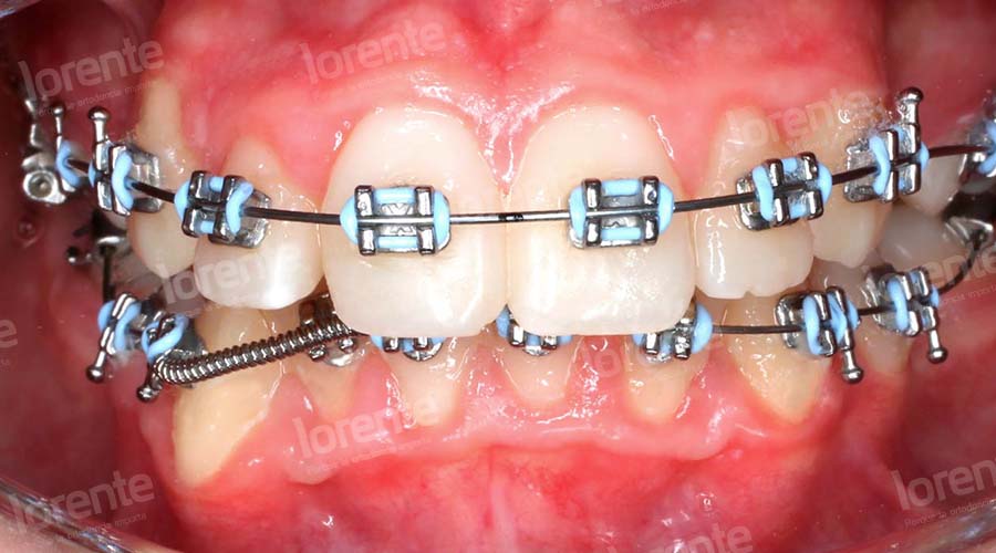 Caso clínico Ortodoncia