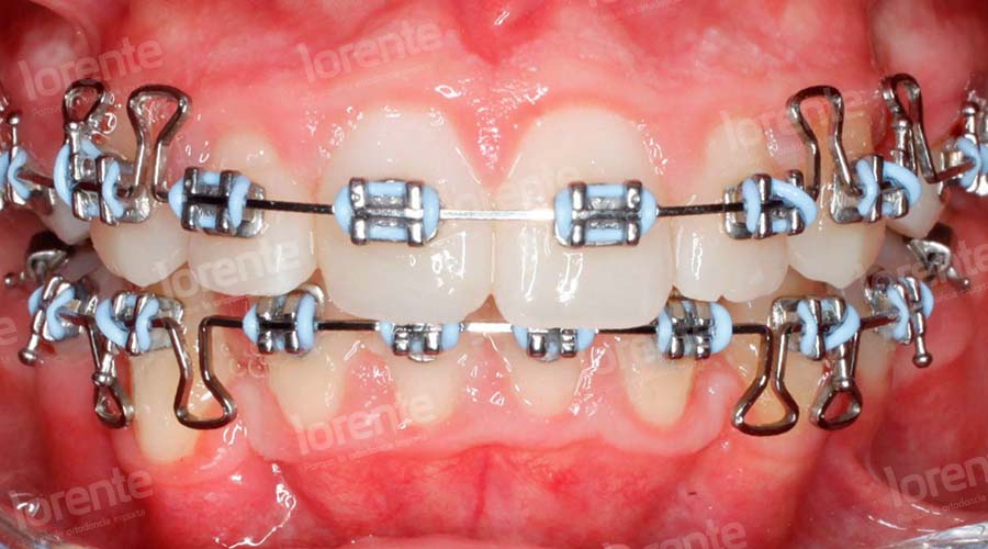 Caso clínico Ortodoncia