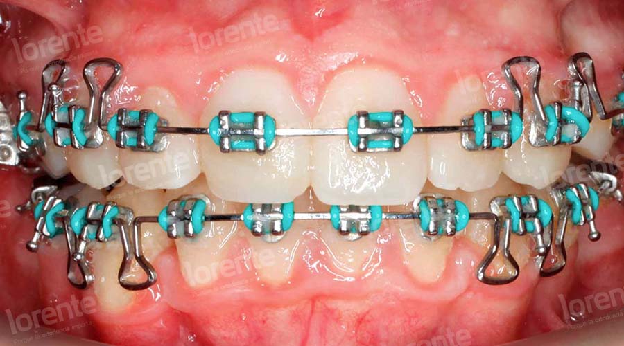 Caso clínico Ortodoncia