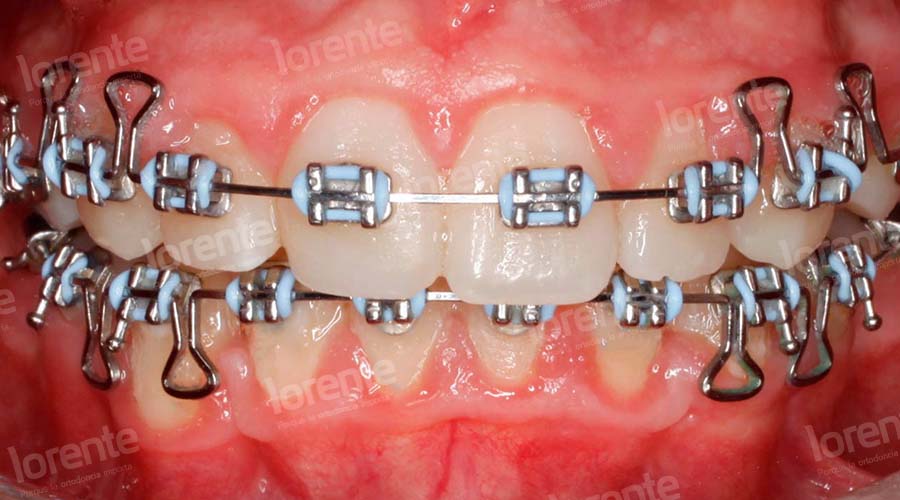 Caso clínico Ortodoncia