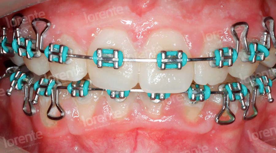 Caso clínico Ortodoncia