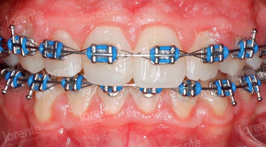 Caso clínico Ortodoncia