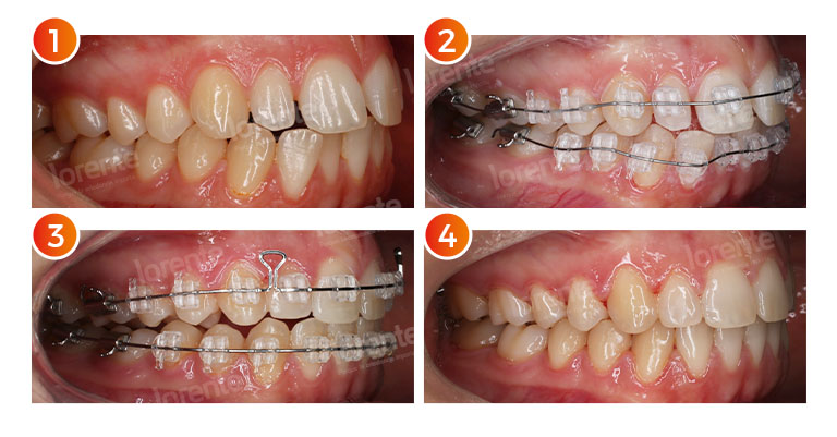 caso-silvia-restauracion-dental